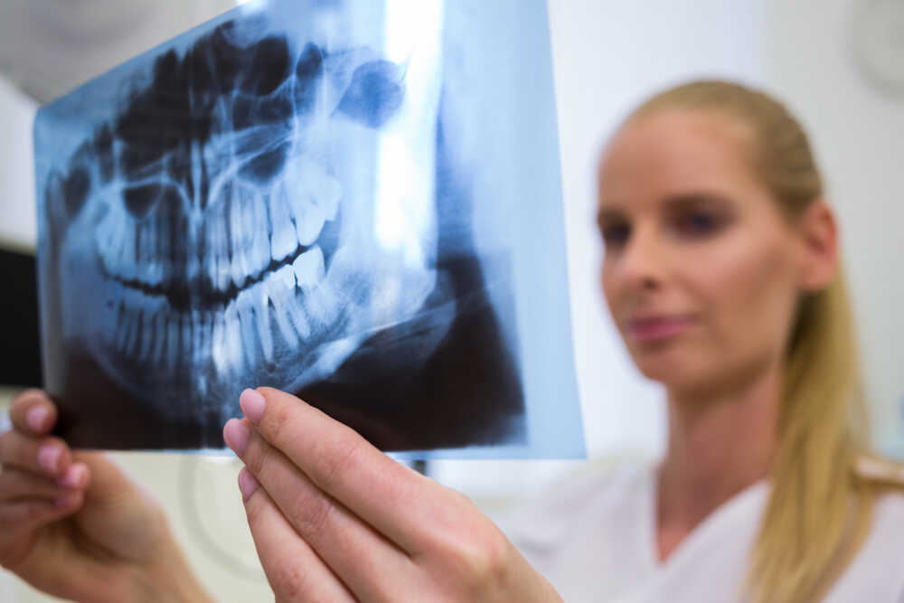 Ile czasu trwa odbudowa kości pod implanty?